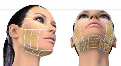 ameliyatsız yüz germe matrix yöntemi