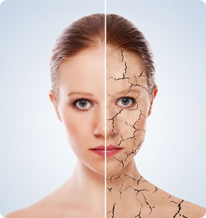 stria çatlak tedavisi